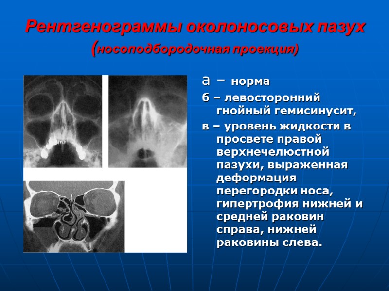 Рентгенограммы околоносовых пазух (носоподбородочная проекция) а – норма б – левосторонний гнойный гемисинусит, 